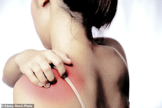 The Hidden Toll of Psoriasis: As Cases Soar, Stigma Persists in the UK