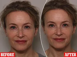 The Hidden Toll of Psoriasis: As Cases Soar, Stigma Persists in the UK