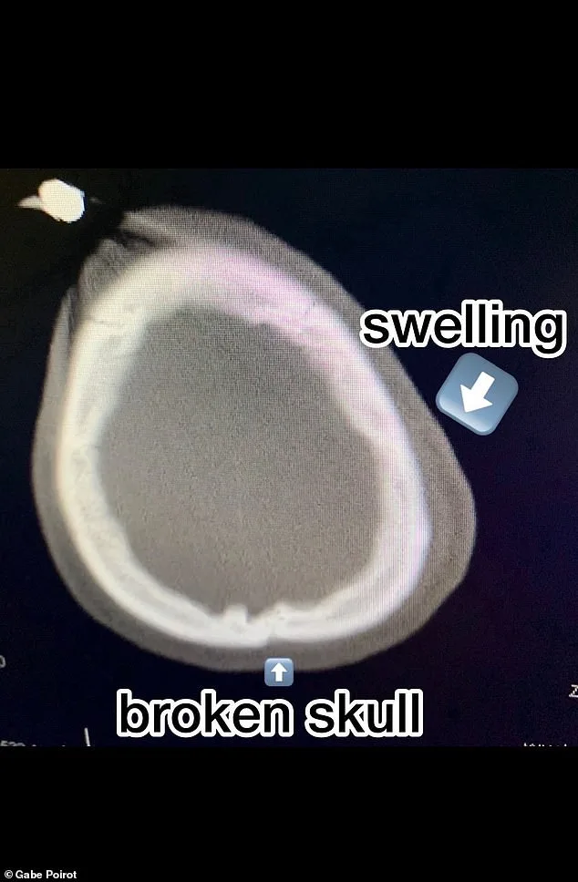 From Near-Death to New Life: Gabe Poirot's Survival After a Skateboard Tragedy