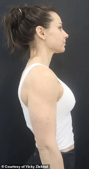 Revolutionary Minimally Invasive Breast Augmentation: Instant Results, No Scars, and Natural Beauty