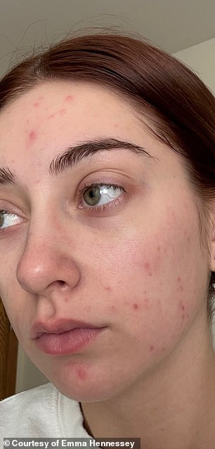 Celebrities use low-dose Accutane for anti-aging without surgery.