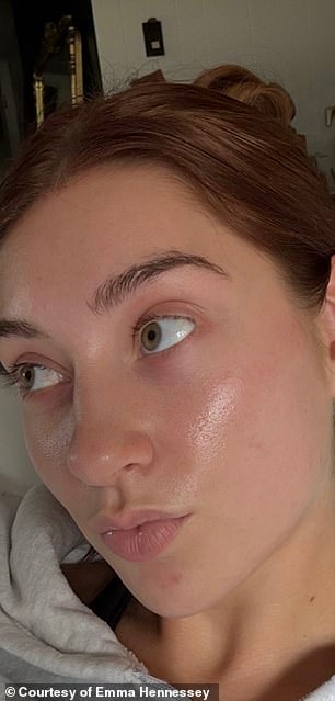 Celebrities use low-dose Accutane for anti-aging without surgery.