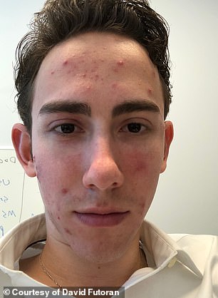 Celebrities use low-dose Accutane for anti-aging without surgery.
