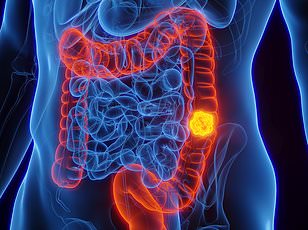 Study Links Birth Weight and Older Fathers to Surge in Young Bowel Cancer Cases